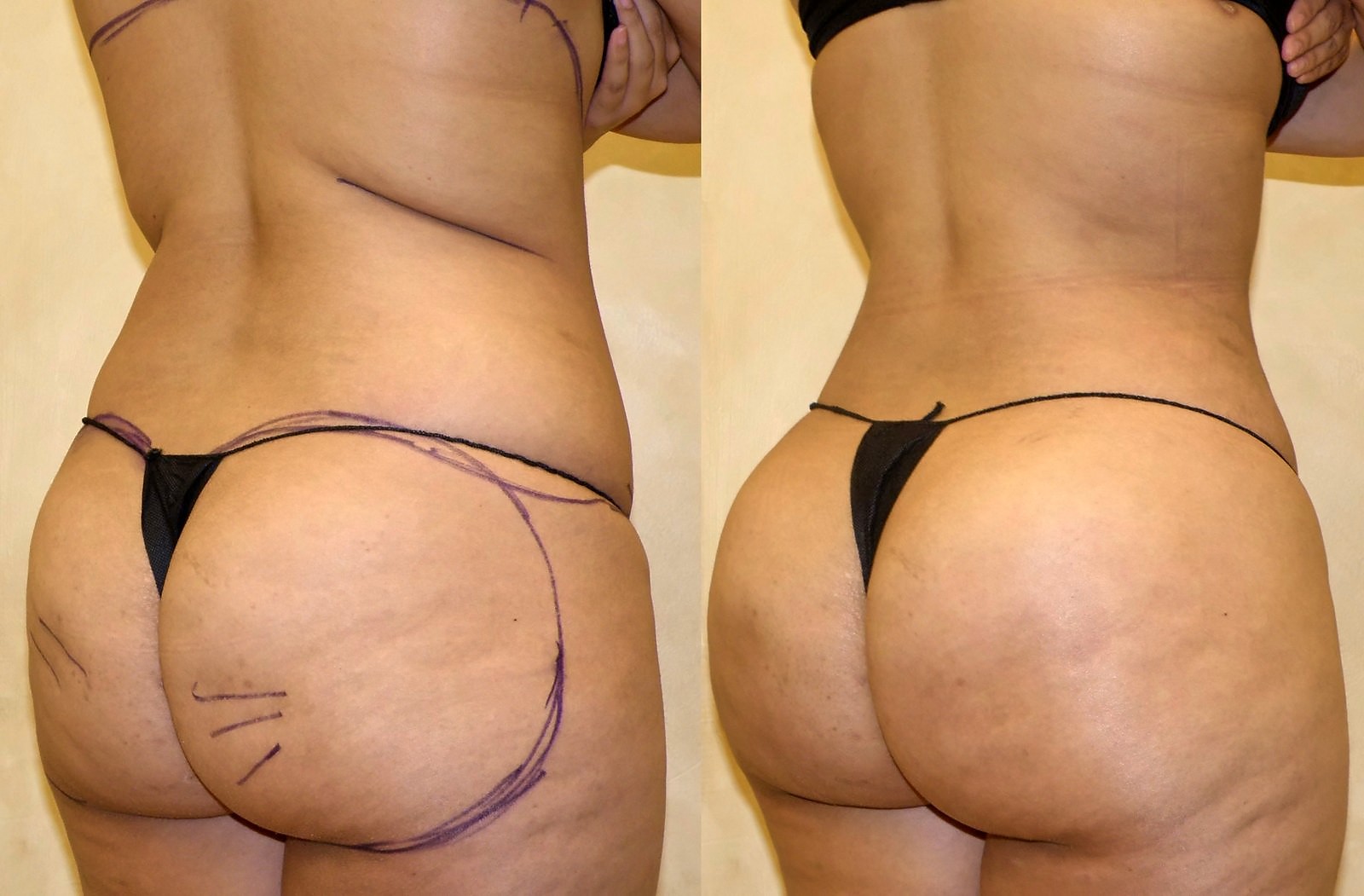 Before/After Fat Transfer, BBL before and after, actual patient of Dr. Long