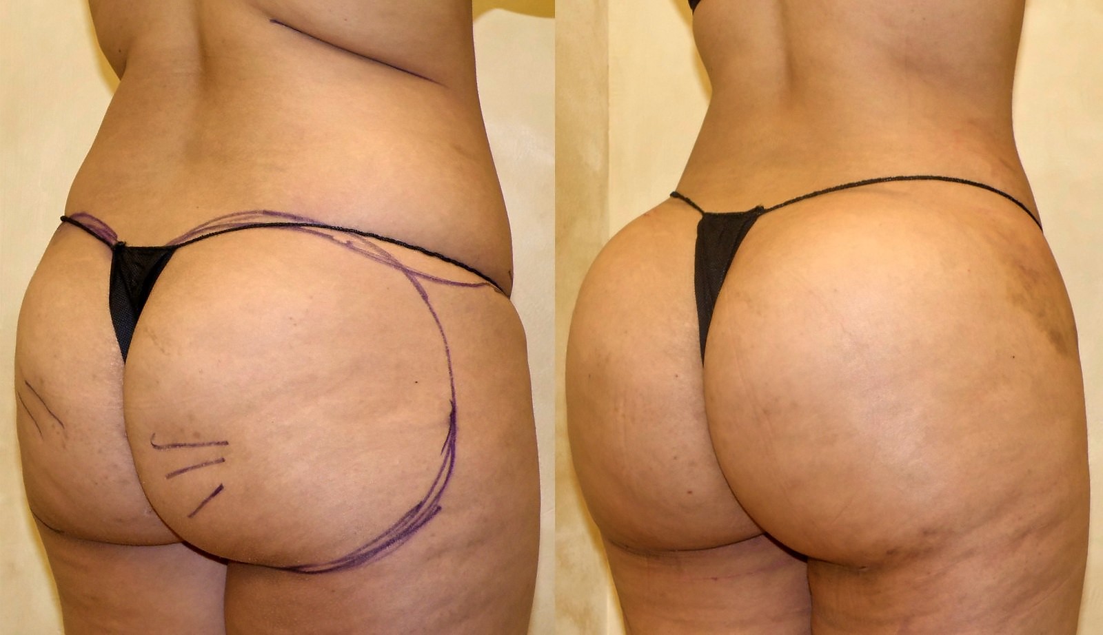 Before/After Fat Transfer, BBL before and after, actual patient of Dr. Long