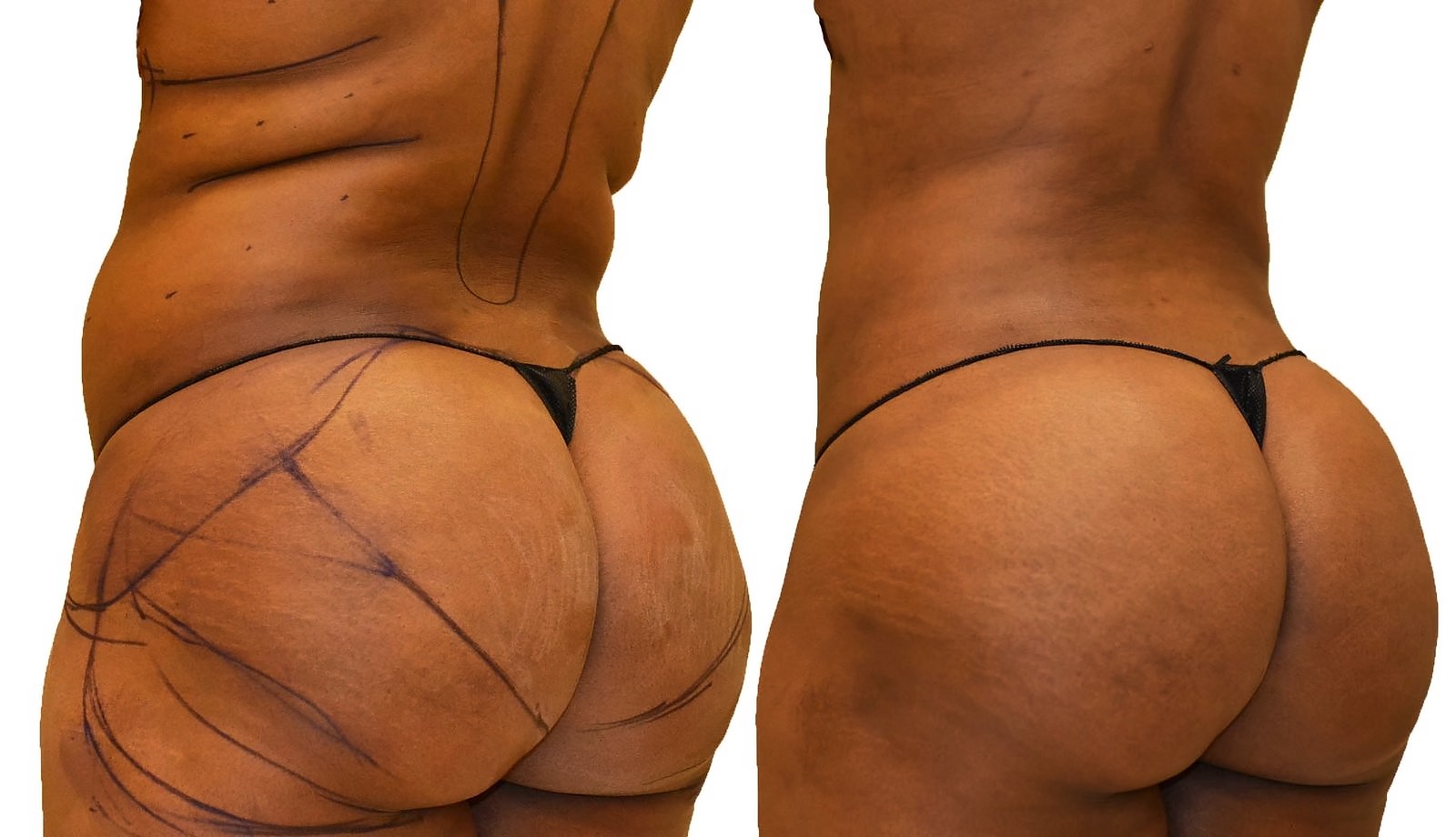 Before/After Fat Transfer, BBL before and after, actual patient of Dr. Long