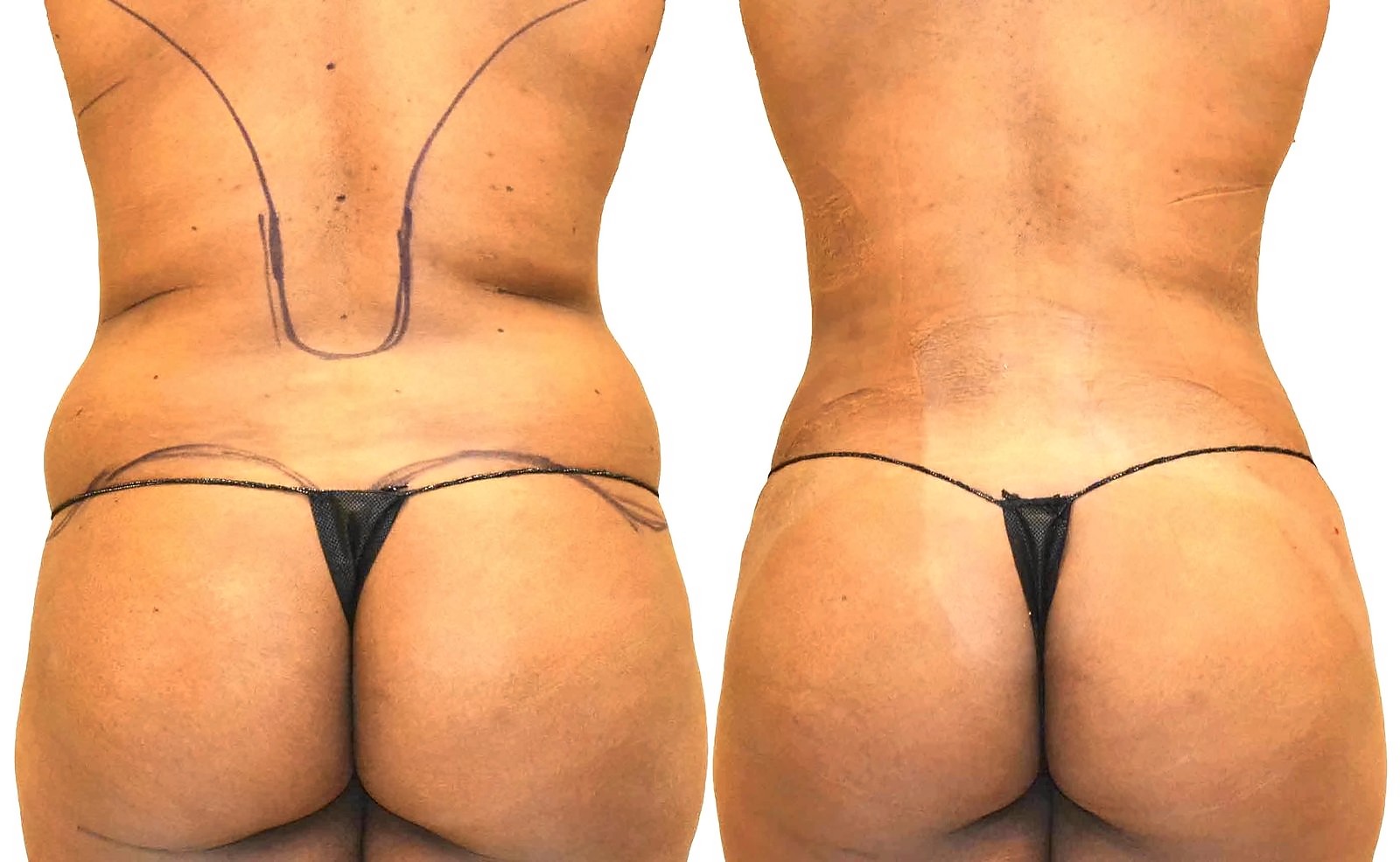 Before/After Fat Transfer, BBL before and after, actual patient of Dr. Long