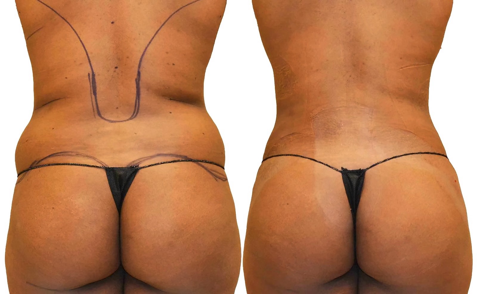 Before/After Fat Transfer, BBL before and after, actual patient of Dr. Long