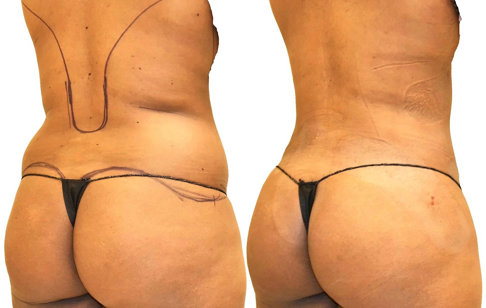 Before/After Fat Transfer, BBL before and after, actual patient of Dr. Long