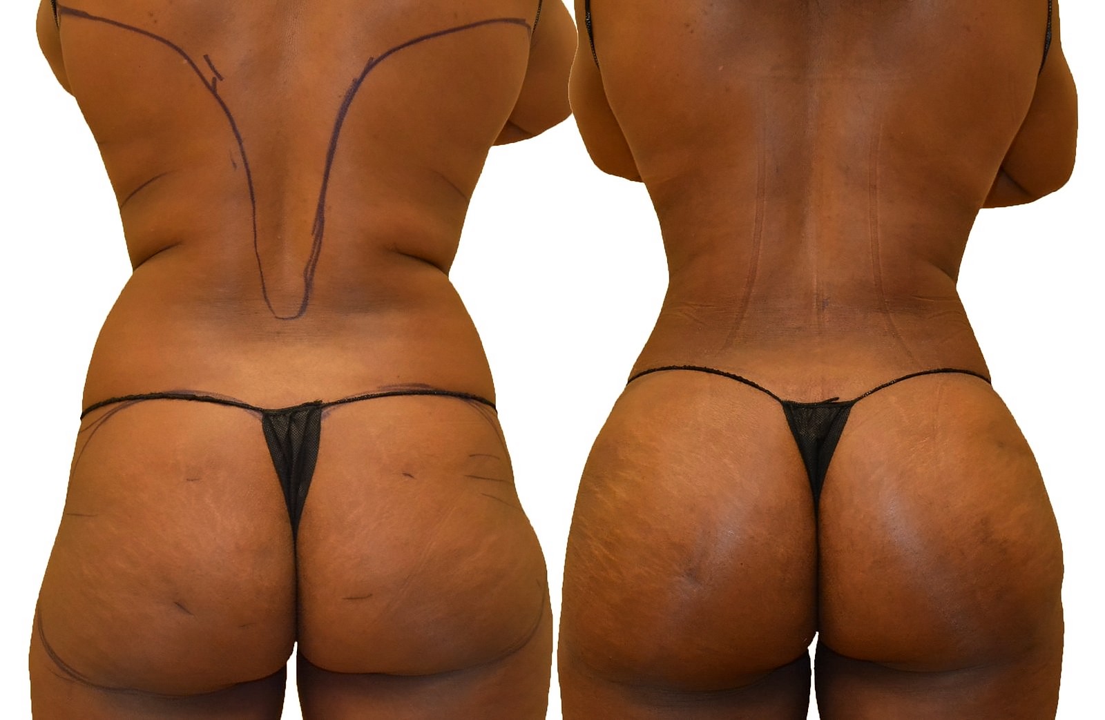 Before/After Fat Transfer, BBL before and after, actual patient of Dr. Long