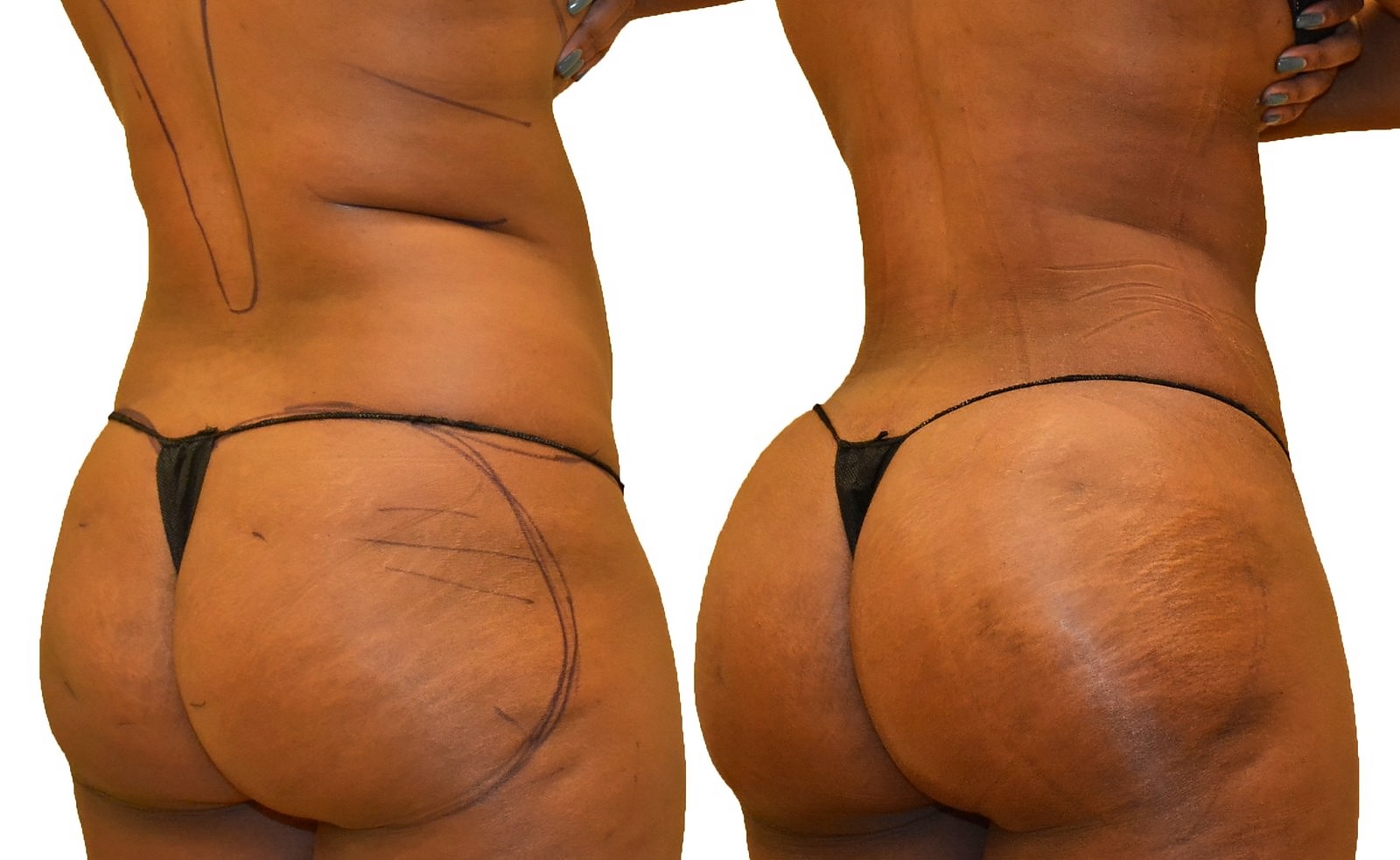 Before/After Fat Transfer, BBL before and after, actual patient of Dr. Long