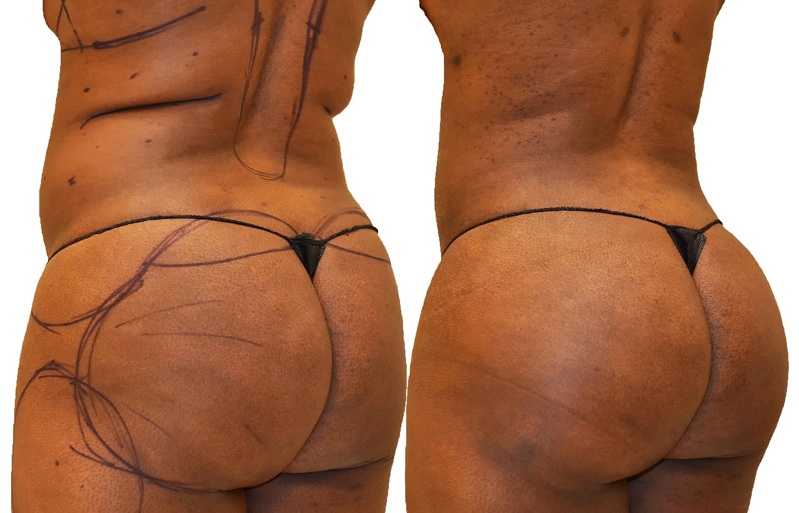 Before/After Fat Transfer, BBL before and after, actual patient of Dr. Long