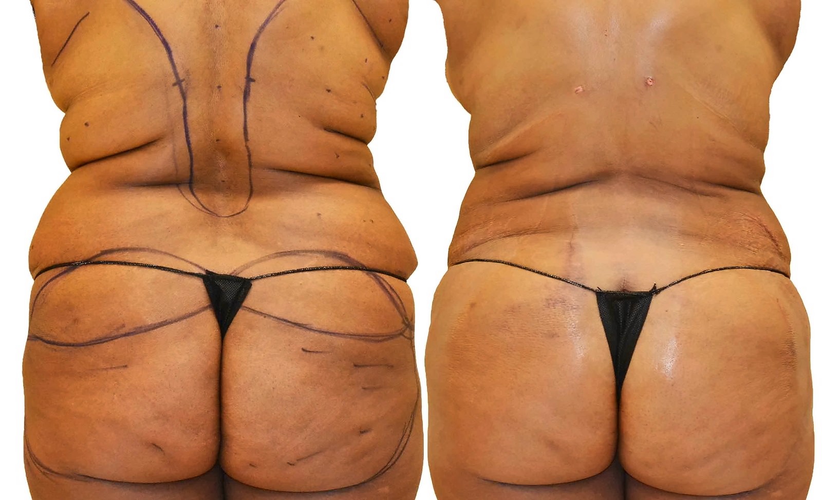 Before/After Fat Transfer, BBL before and after, actual patient of Dr. Long