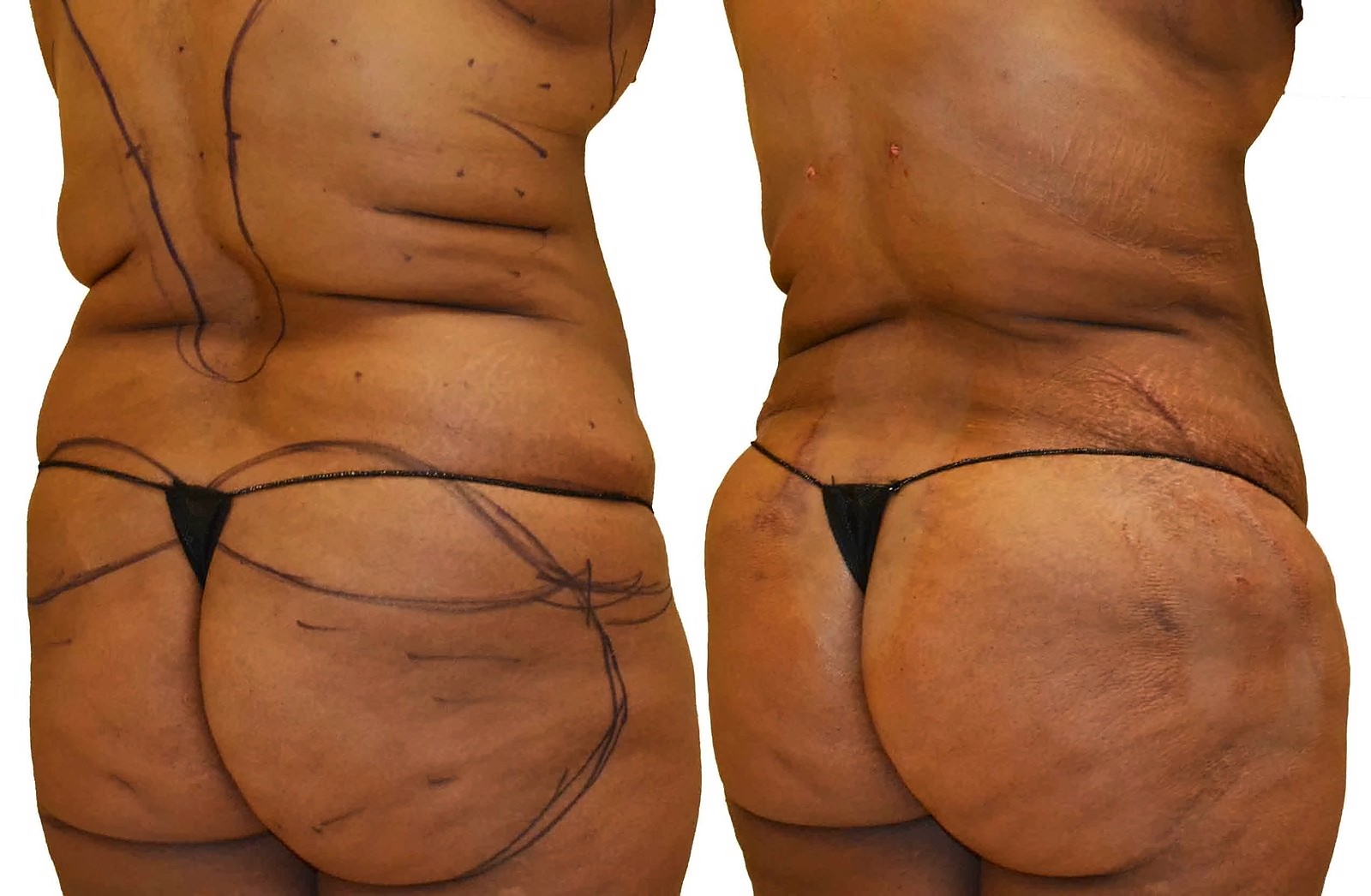 Before/After Fat Transfer, BBL before and after, actual patient of Dr. Long
