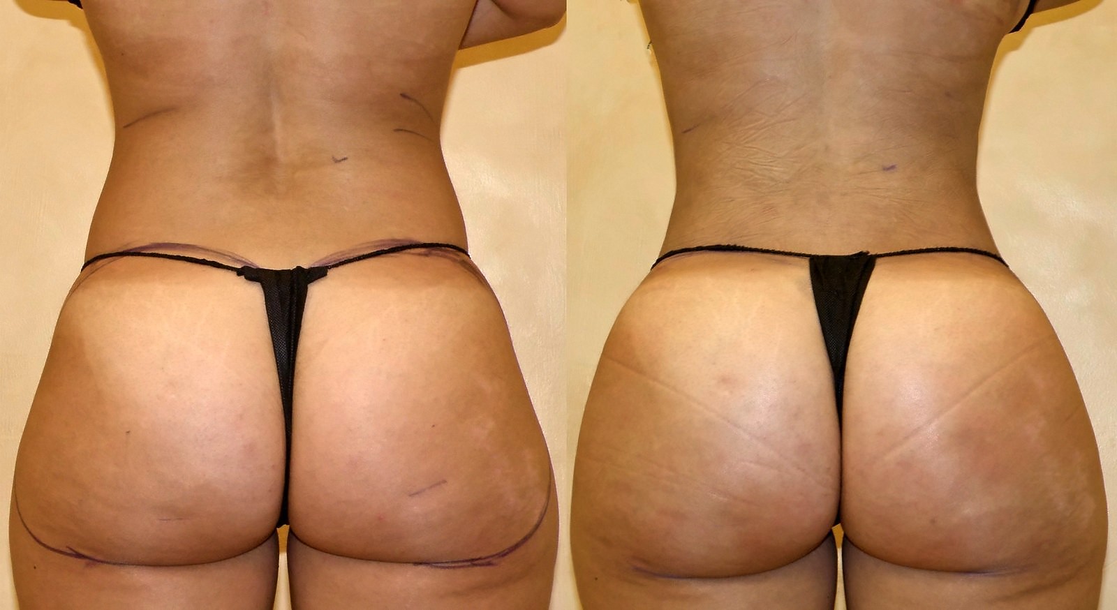 Before/After Fat Transfer, BBL before and after, actual patient of Dr. Long