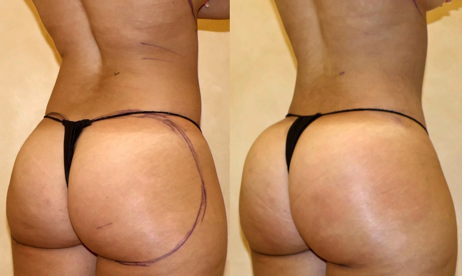 Before/After Fat Transfer, BBL before and after, actual patient of Dr. Long