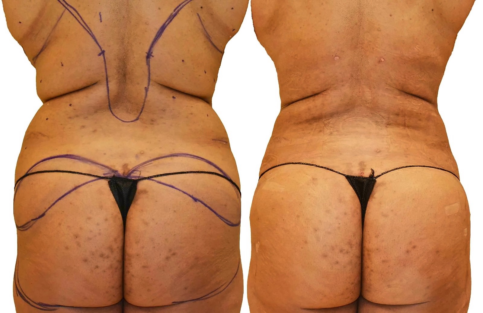 Before/After Fat Transfer, BBL before and after, actual patient of Dr. Long