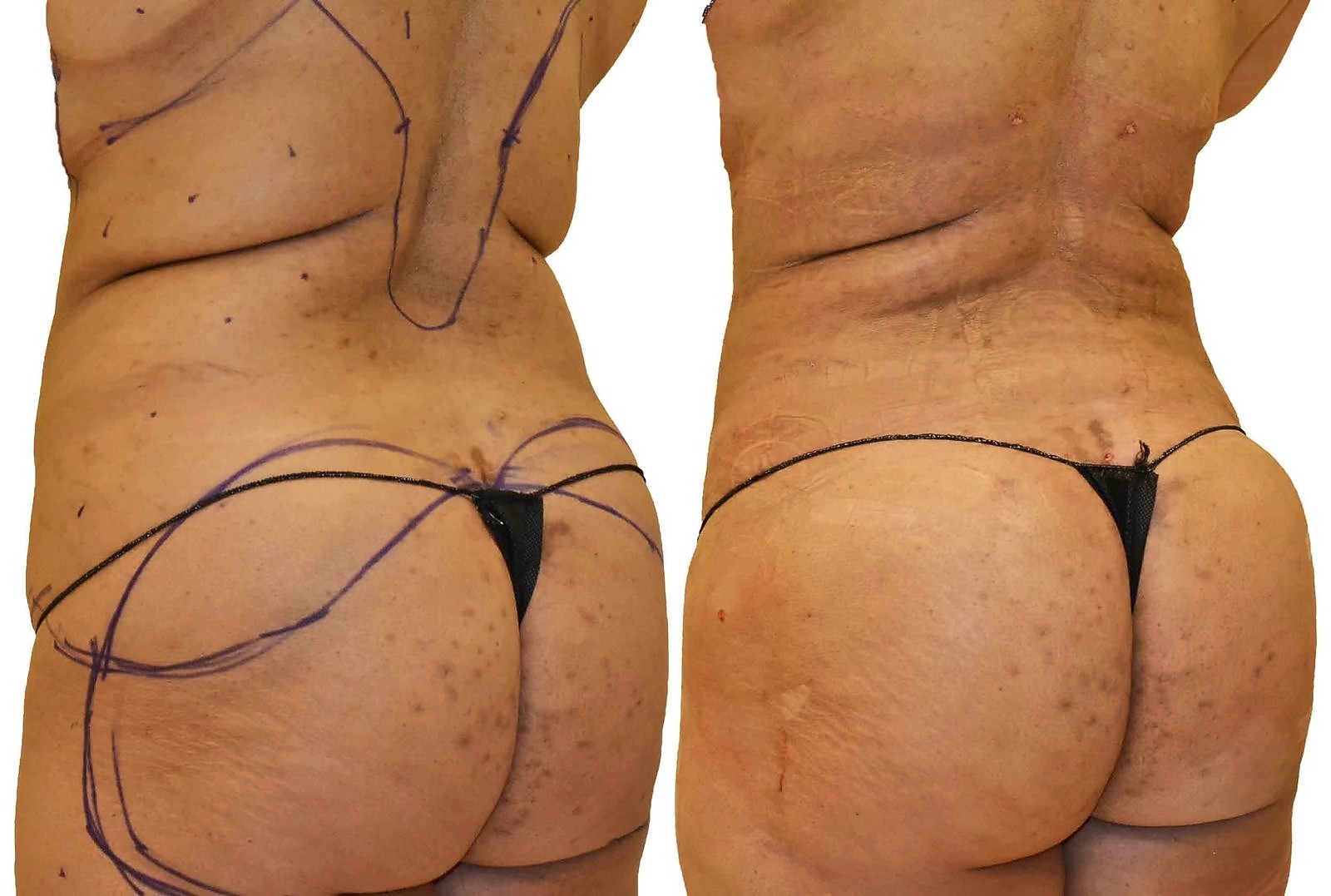 Before/After Fat Transfer, BBL before and after, actual patient of Dr. Long