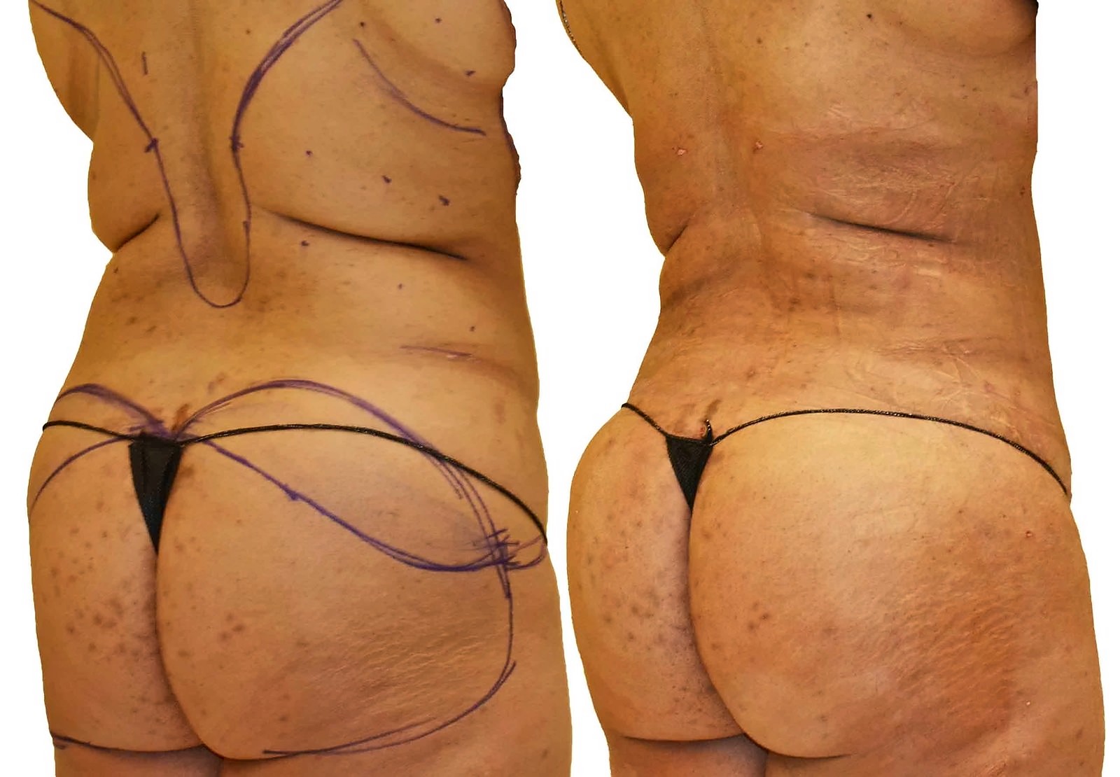 Before/After Fat Transfer, BBL before and after, actual patient of Dr. Long
