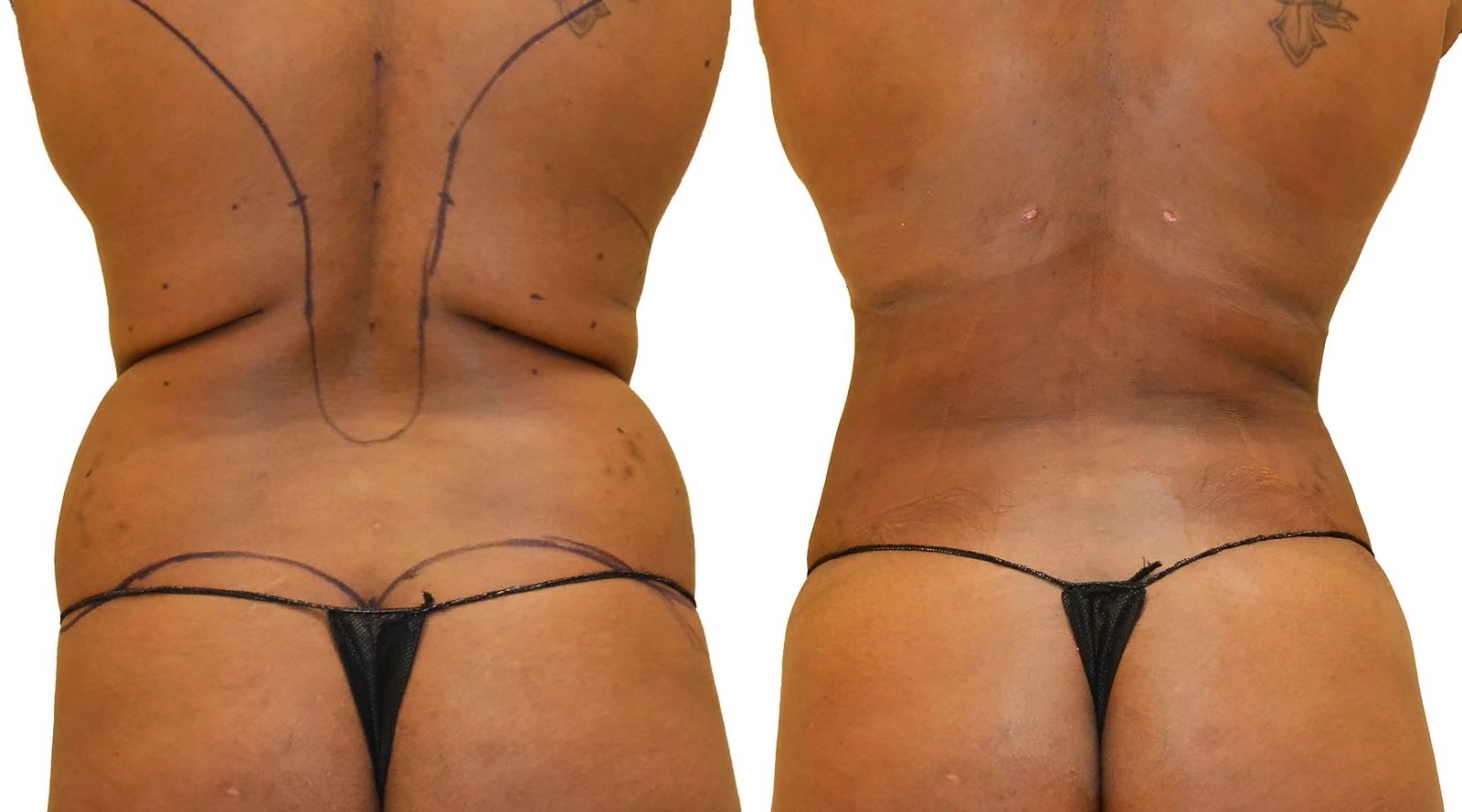 Before/After Fat Transfer, BBL before and after, actual patient of Dr. Long