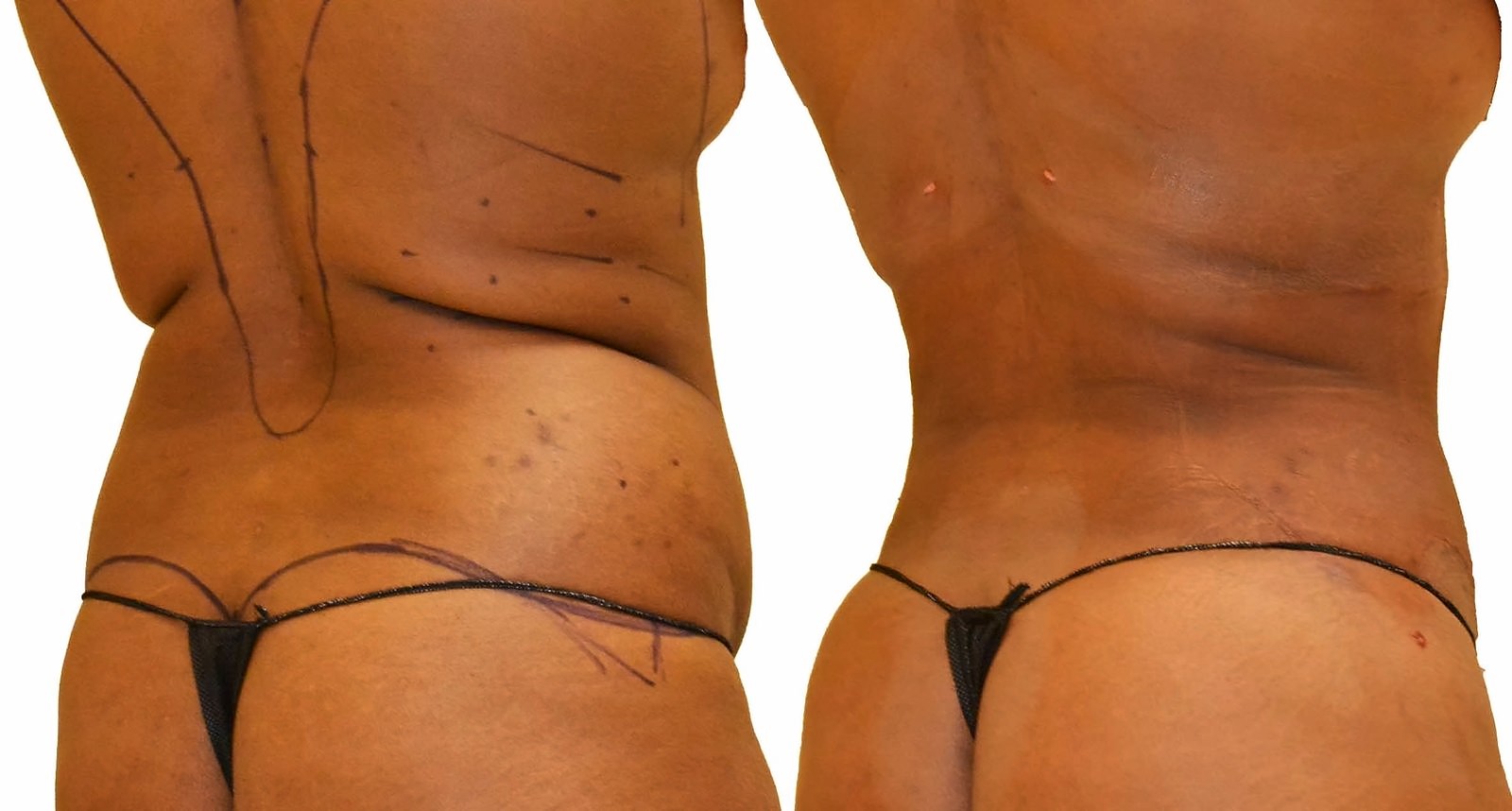 Before/After Fat Transfer, BBL before and after, actual patient of Dr. Long