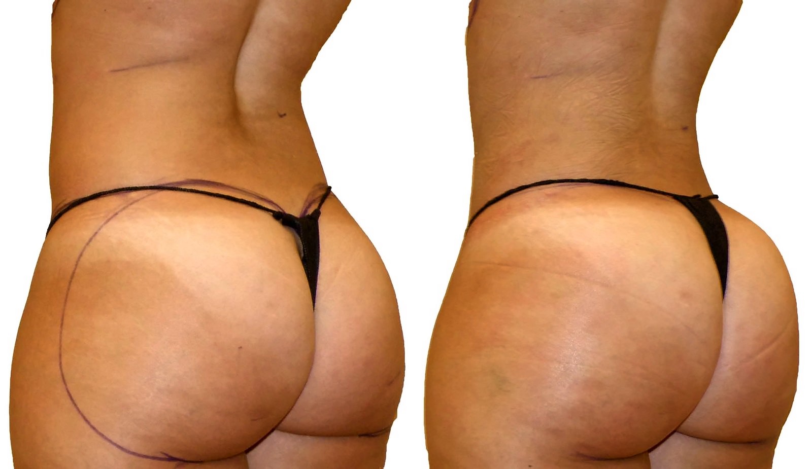 Before/After Fat Transfer, BBL before and after, actual patient of Dr. Long