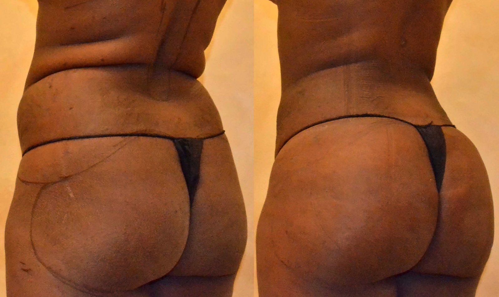 Before/After Fat Transfer, BBL before and after, actual patient of Dr. Long