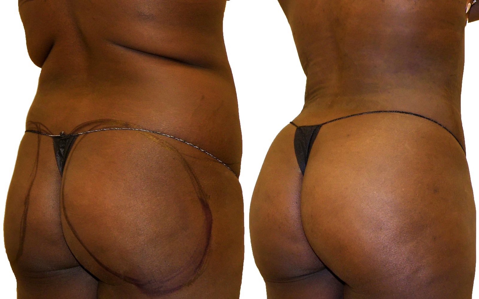 Before/After Fat Transfer, BBL before and after, actual patient of Dr. Long