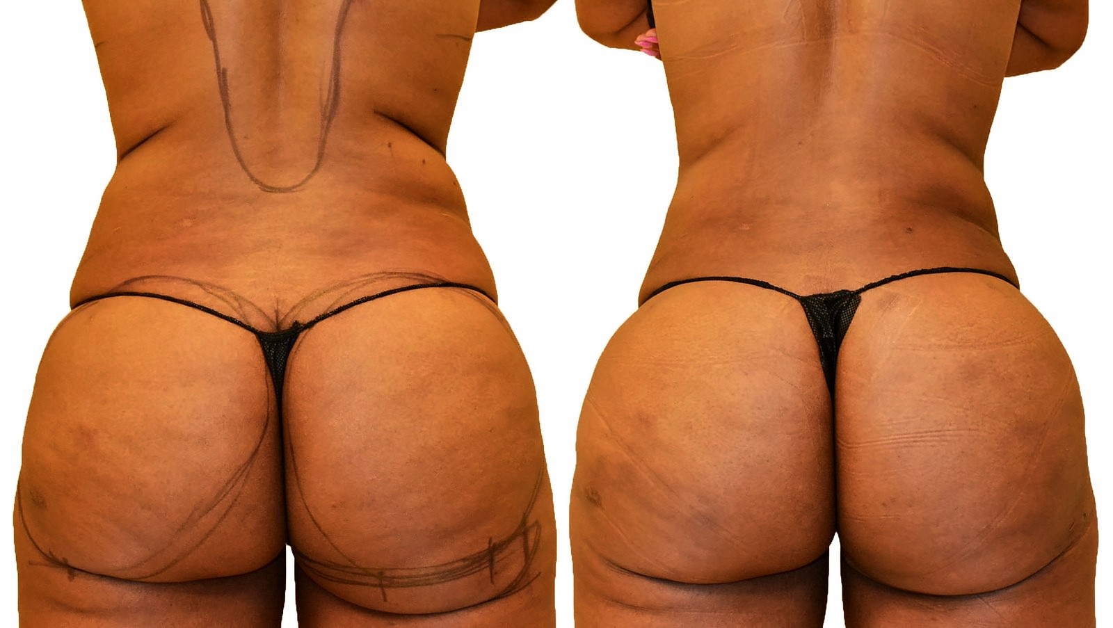 Before/After Fat Transfer, BBL before and after, actual patient of Dr. Long