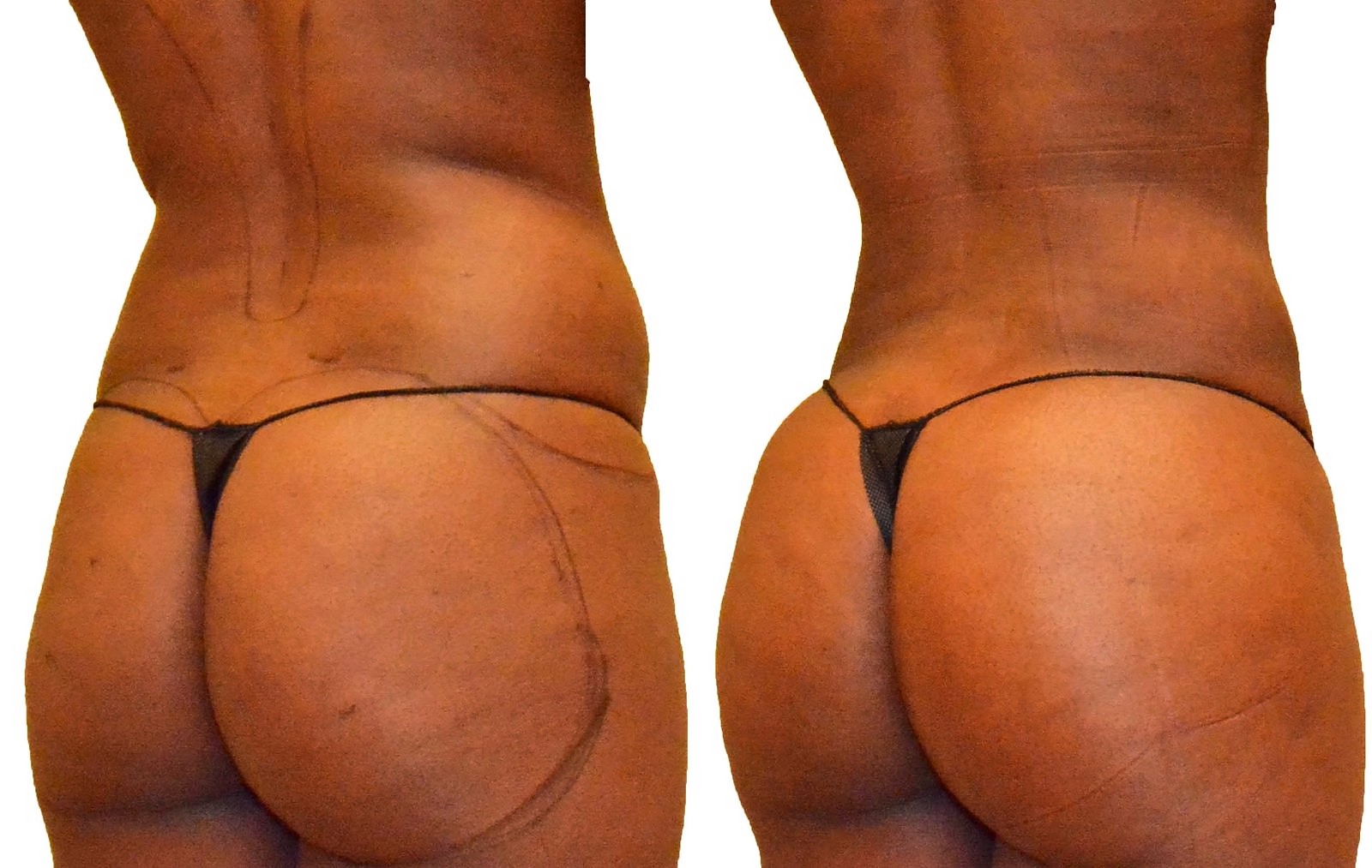 Before/After Fat Transfer, BBL before and after, actual patient of Dr. Long