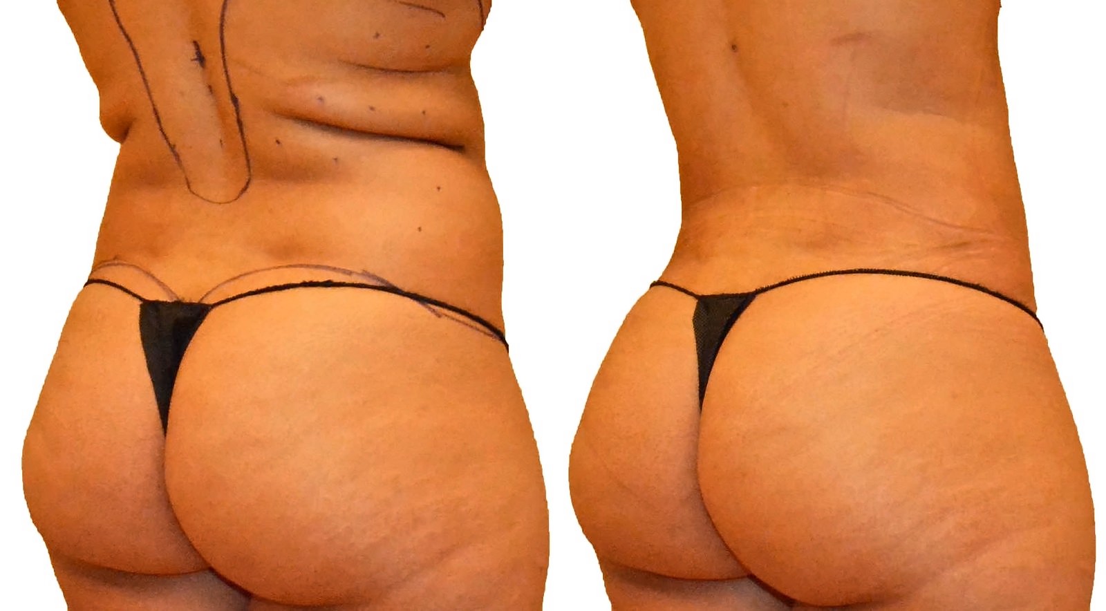 Before/After Fat Transfer, BBL before and after, actual patient of Dr. Long