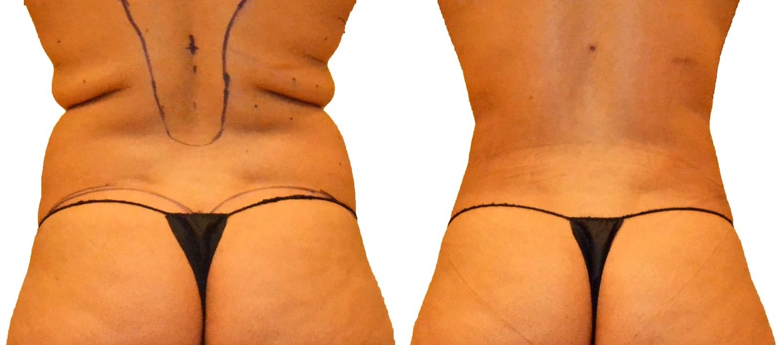 Before/After Fat Transfer, BBL before and after, actual patient of Dr. Long