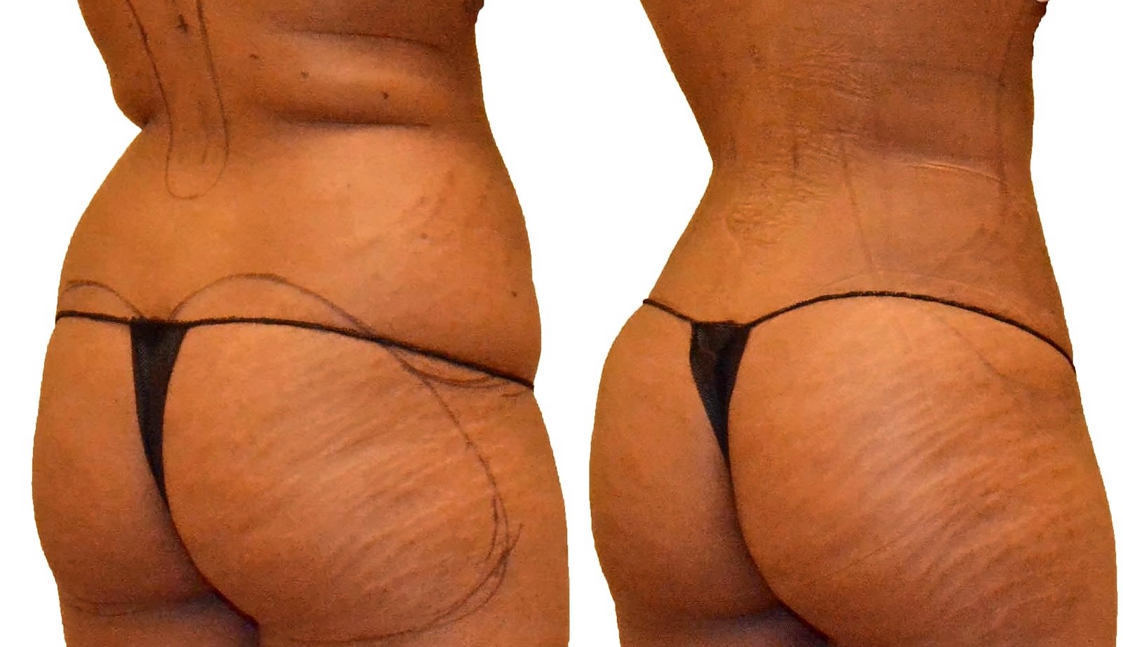 Before/After Fat Transfer, BBL before and after, actual patient of Dr. Long