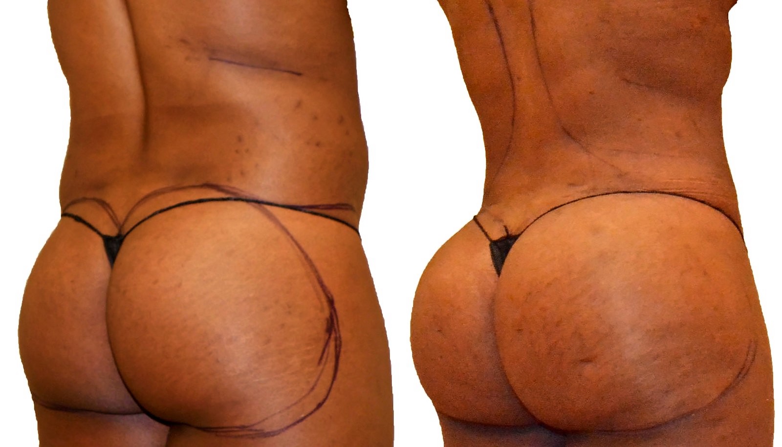 Before/After Fat Transfer, BBL before and after, actual patient of Dr. Long