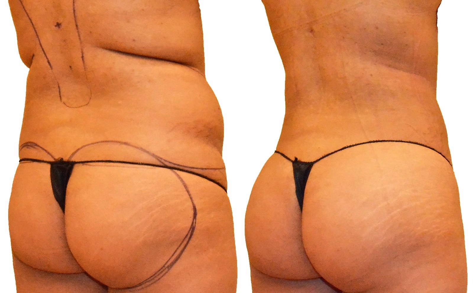 Before/After Fat Transfer, BBL before and after, actual patient of Dr. Long
