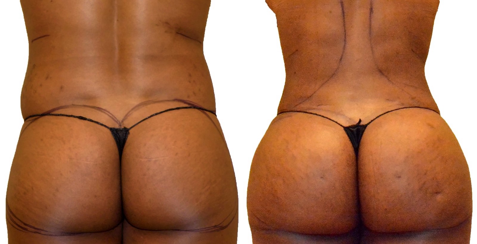 Before/After Fat Transfer, BBL before and after, actual patient of Dr. Long