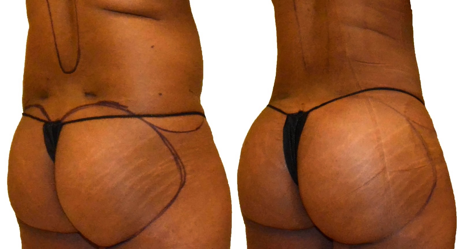 Before/After Fat Transfer, BBL before and after, actual patient of Dr. Long