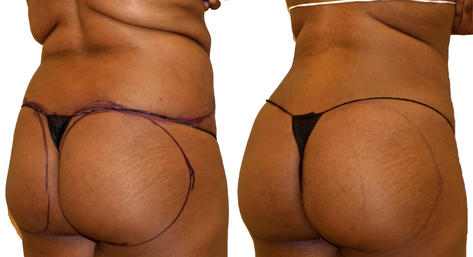 Before/After Fat Transfer, BBL before and after, actual patient of Dr. Long