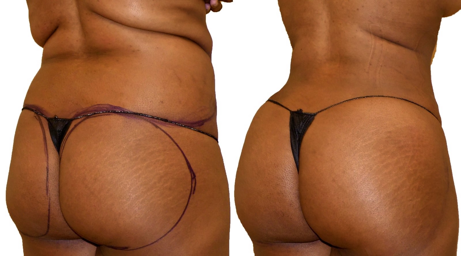 Before/After Fat Transfer, BBL before and after, actual patient of Dr. Long