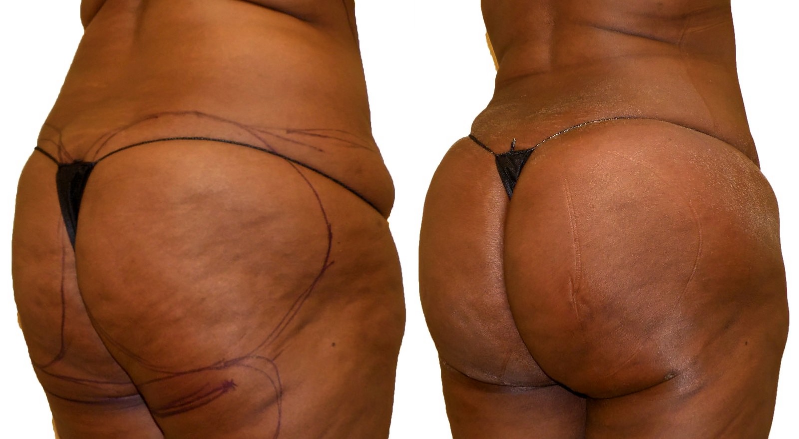 Before/After Fat Transfer, BBL before and after, actual patient of Dr. Long