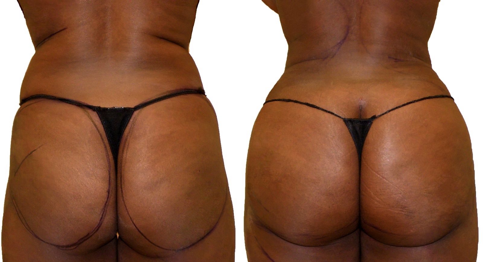 Before/After Fat Transfer, BBL before and after, actual patient of Dr. Long