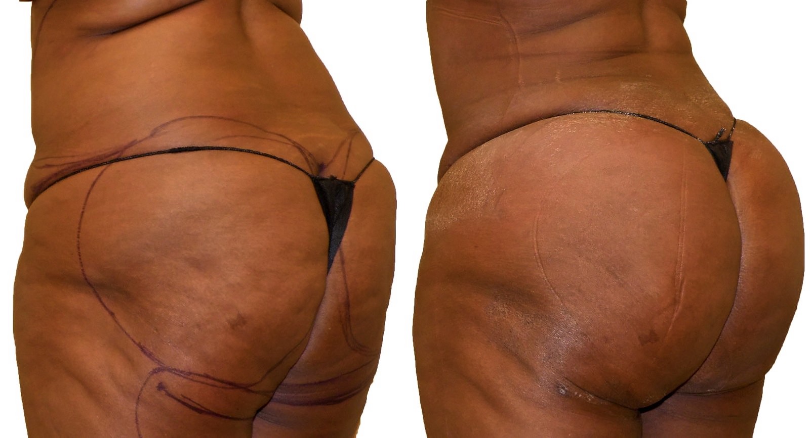 Before/After Fat Transfer, BBL before and after, actual patient of Dr. Long