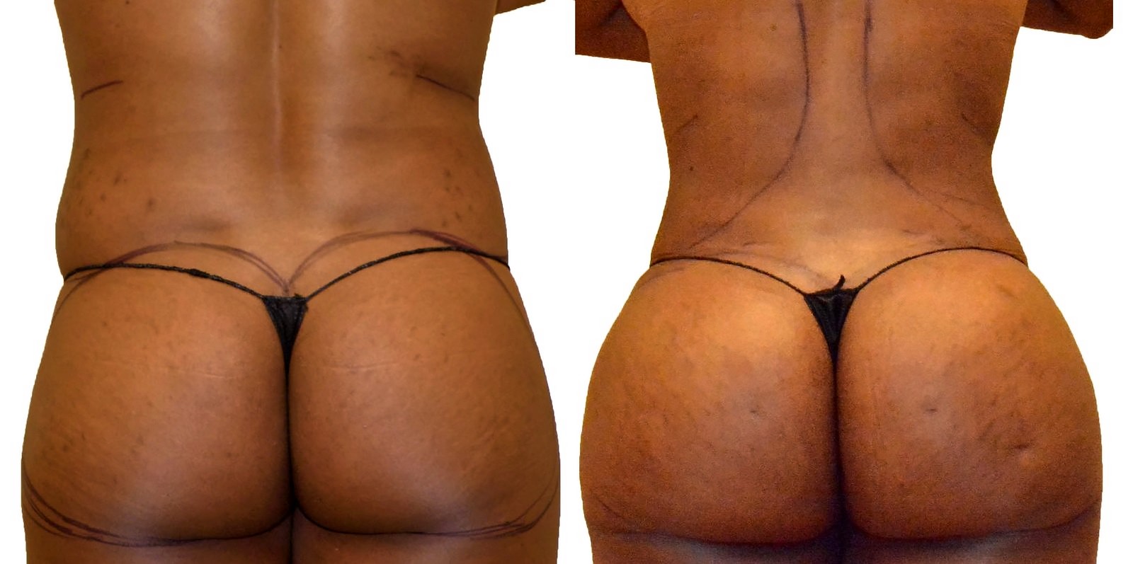 Before/After Fat Transfer, BBL before and after, actual patient of Dr. Long