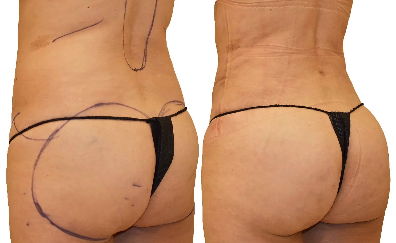 Before/After Fat Transfer, BBL before and after, actual patient of Dr. Long
