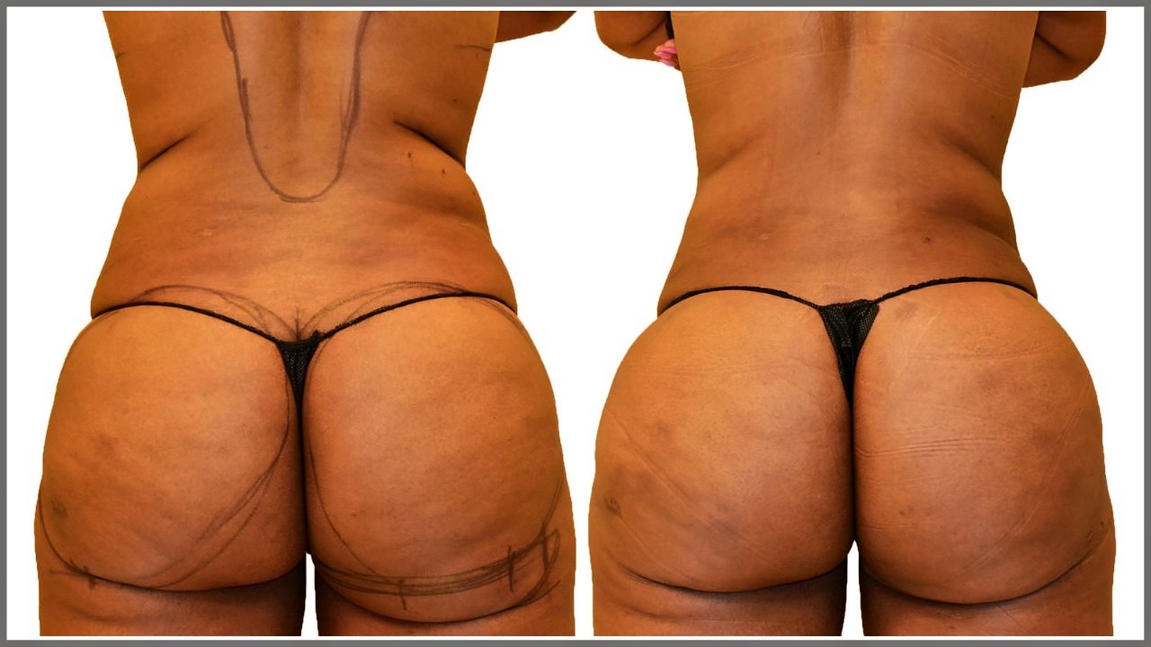 Before/After Fat Transfer, BBL before and after, actual patient of Dr. Long
