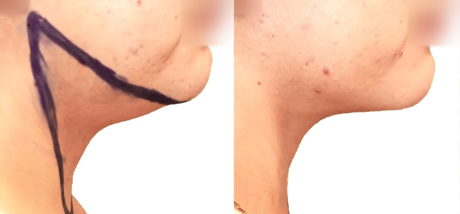 Before/After Chin and neck liposuction before and after, actual patient of Dr. Long