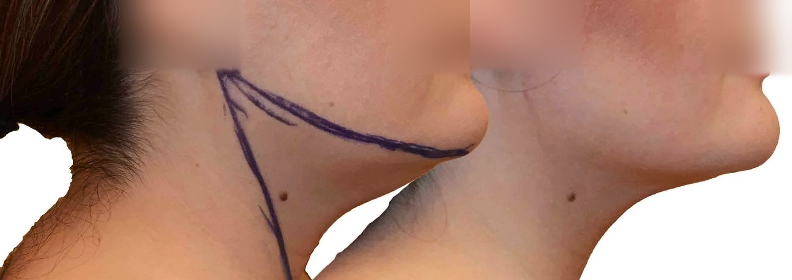 Before/After Chin and neck liposuction before and after, actual patient of Dr. Long