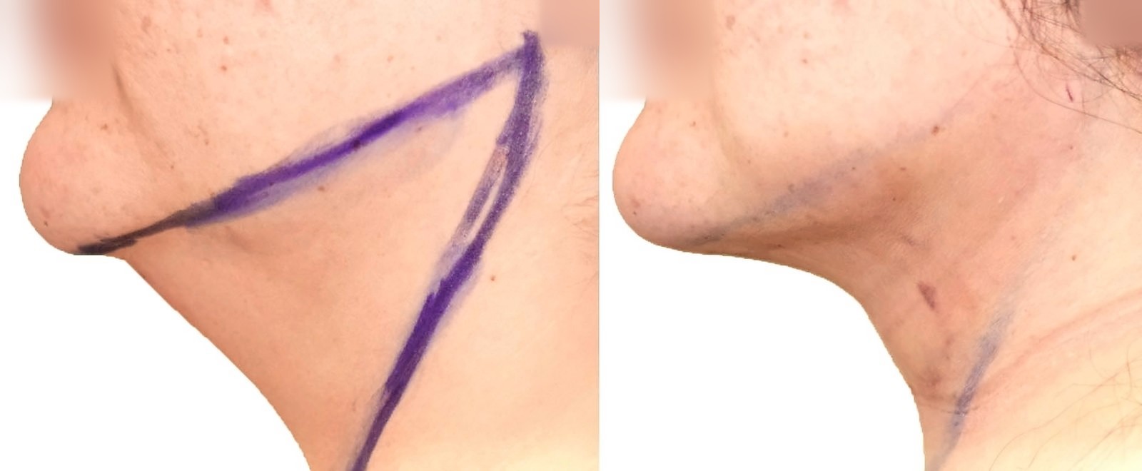 Before/After Chin and neck liposuction before and after, actual patient of Dr. Long