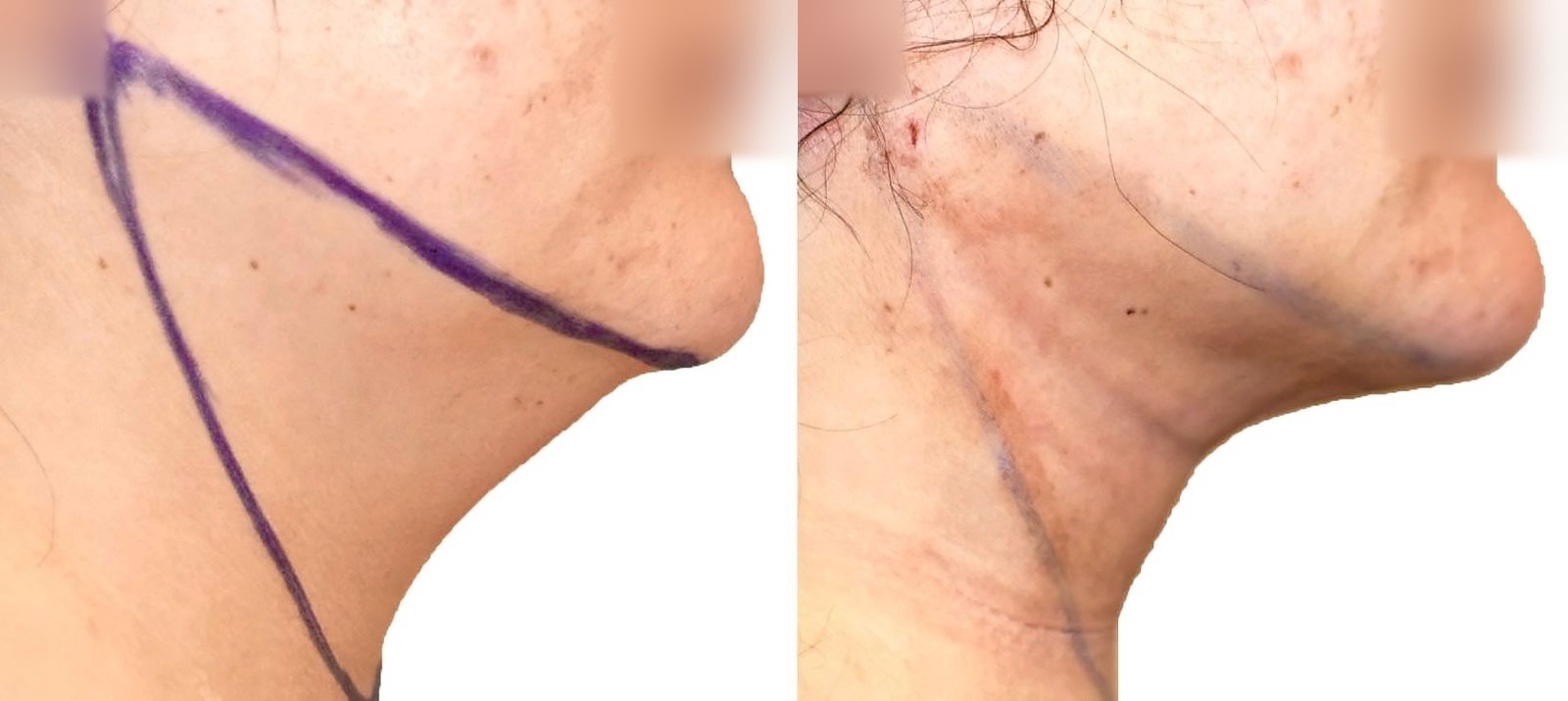 Before/After Chin and neck liposuction before and after, actual patient of Dr. Long