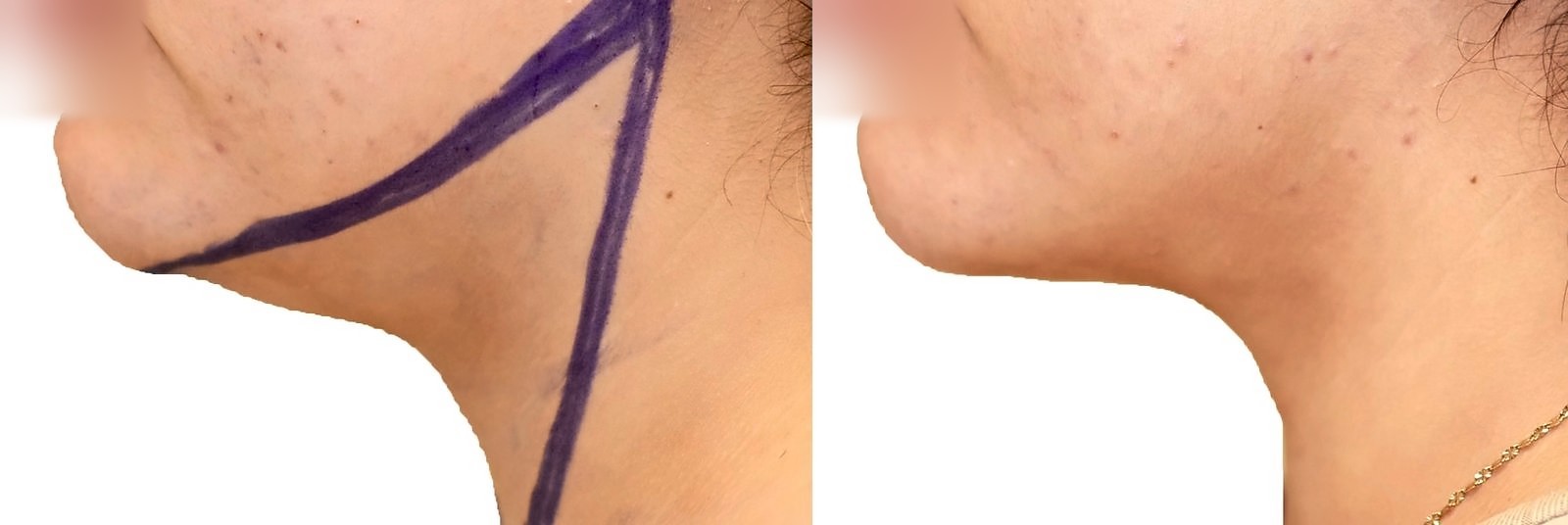Before/After Chin and neck liposuction before and after, actual patient of Dr. Long