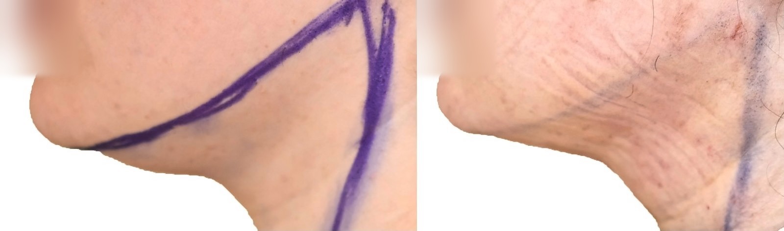 Before/After Chin and neck liposuction before and after, actual patient of Dr. Long