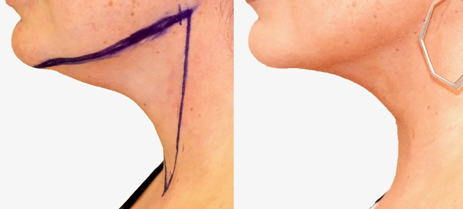 Before/After Chin and neck liposuction before and after, actual patient of Dr. Long