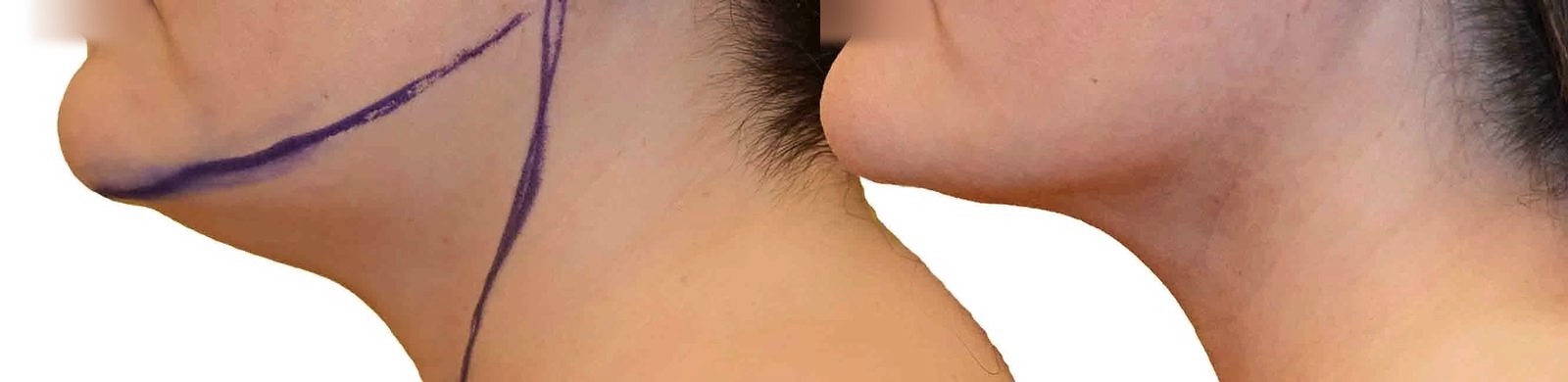 Before/After Chin and neck liposuction before and after, actual patient of Dr. Long