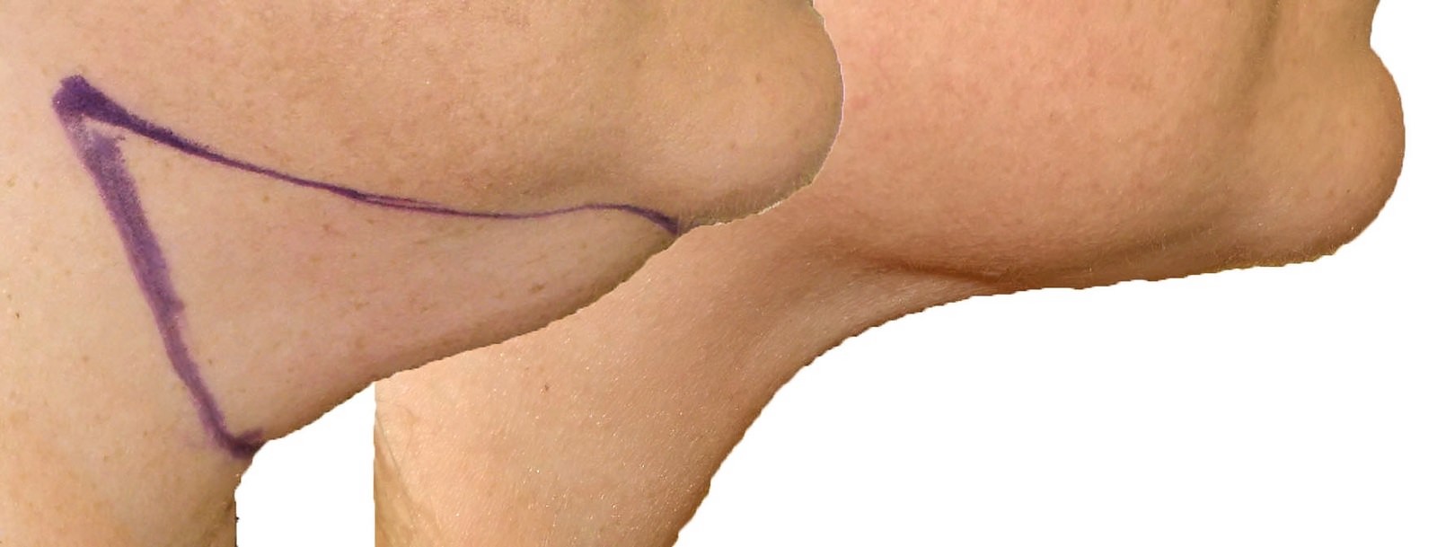 Before/After Chin and neck liposuction before and after, actual patient of Dr. Long