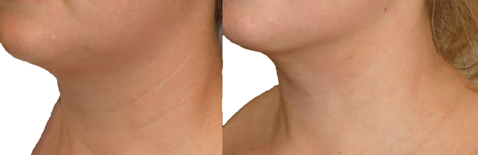 Before/After Chin and neck liposuction before and after, actual patient of Dr. Long