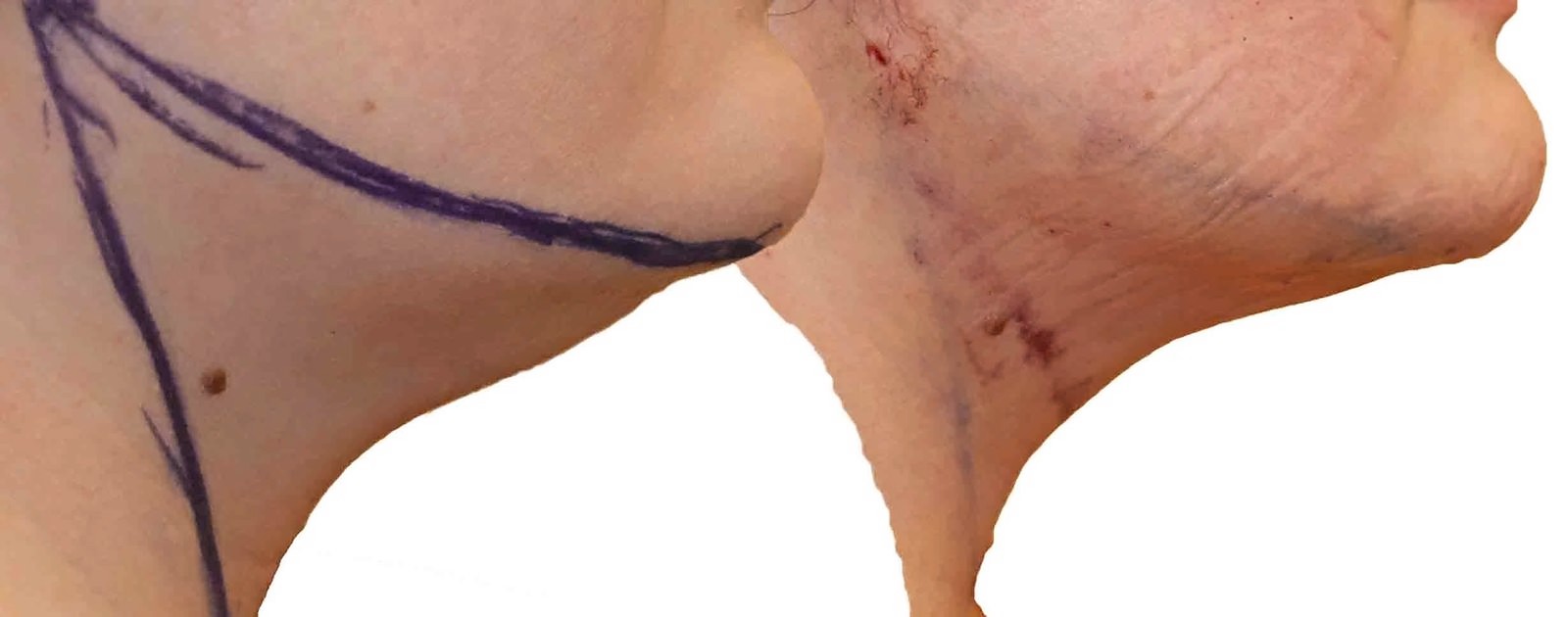 Before/After Chin and neck liposuction before and after, actual patient of Dr. Long