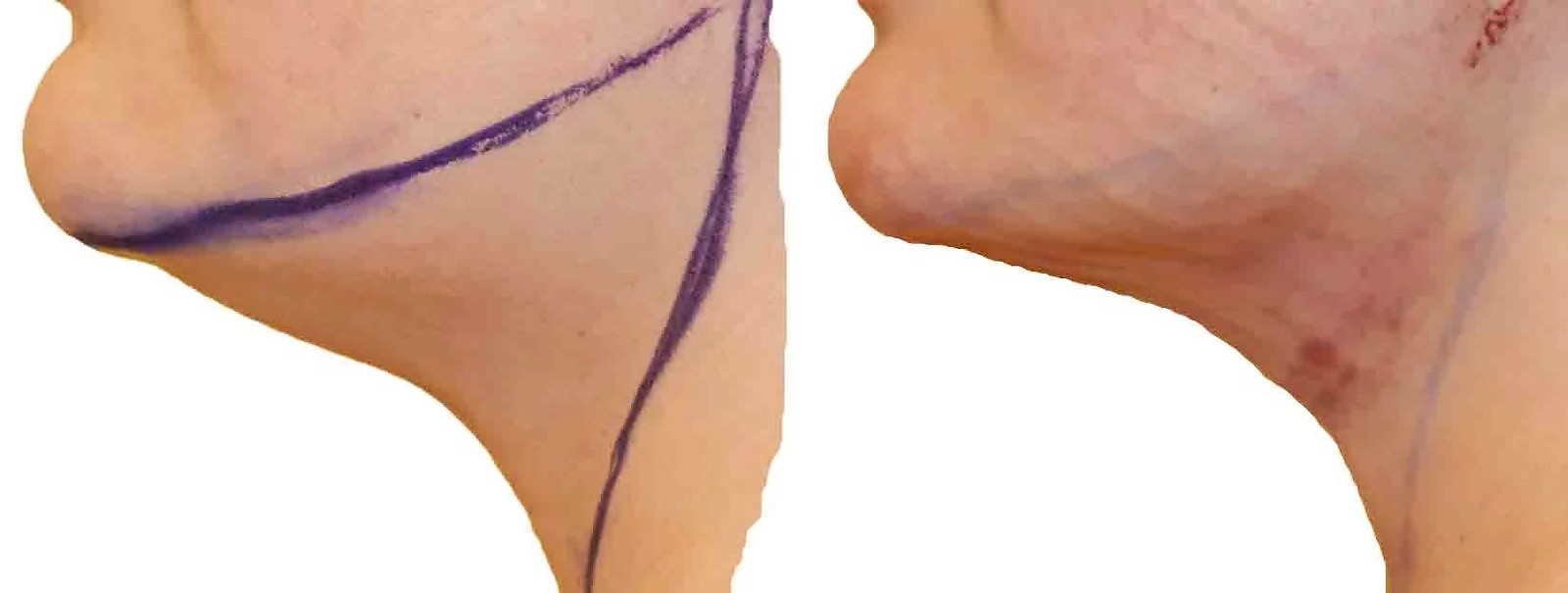 Before/After Chin and neck liposuction before and after, actual patient of Dr. Long